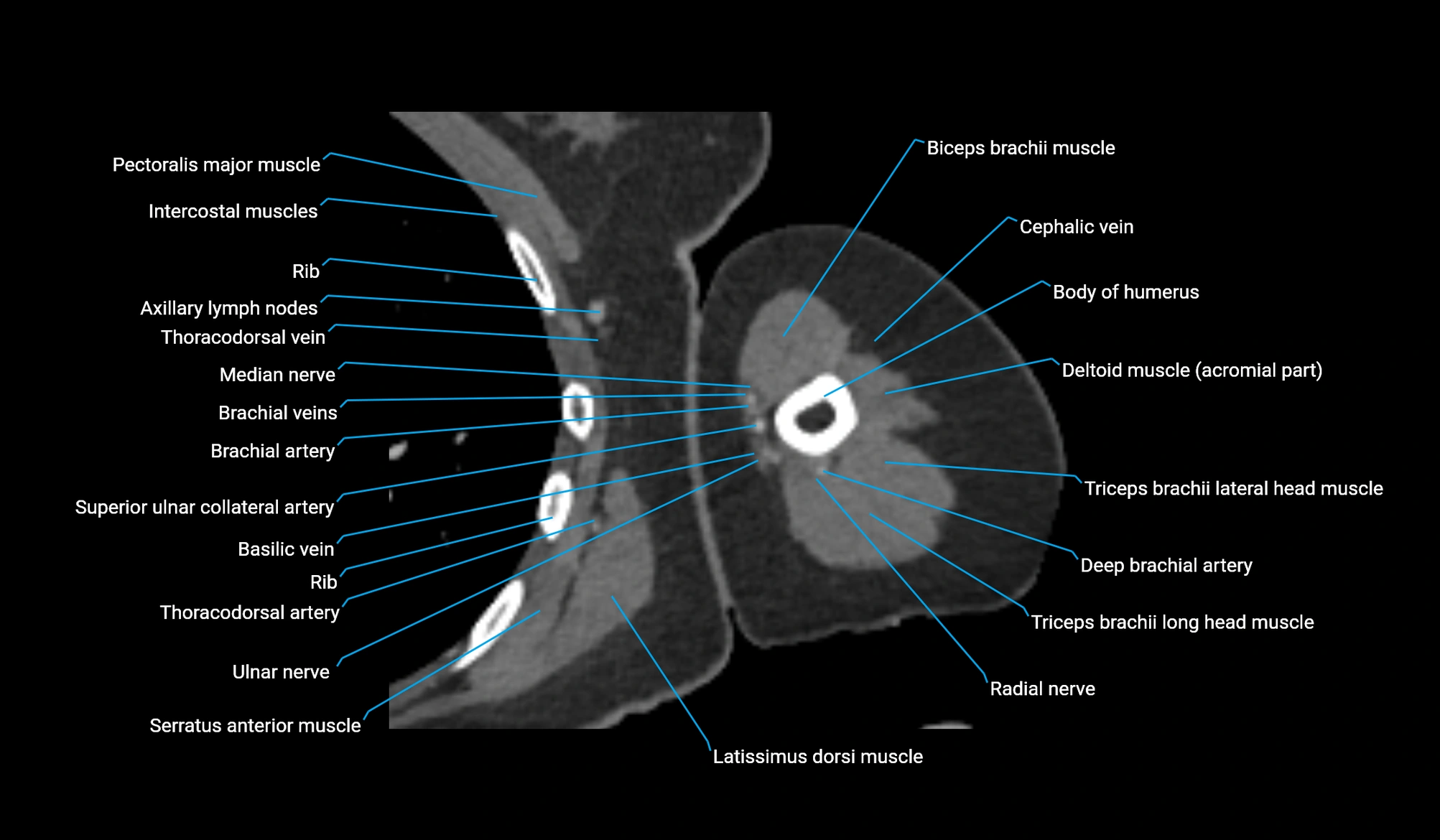 CT upper arm axial  cross sectional anatomy labelled radiology image -00204.webp